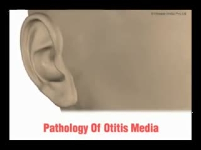Orta Kulak İltihabı (Otitis Media)